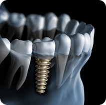 Falência peri-implantar